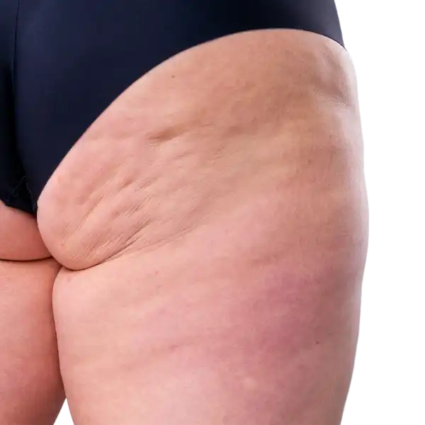 Cellulite on legs, hips and buttocks